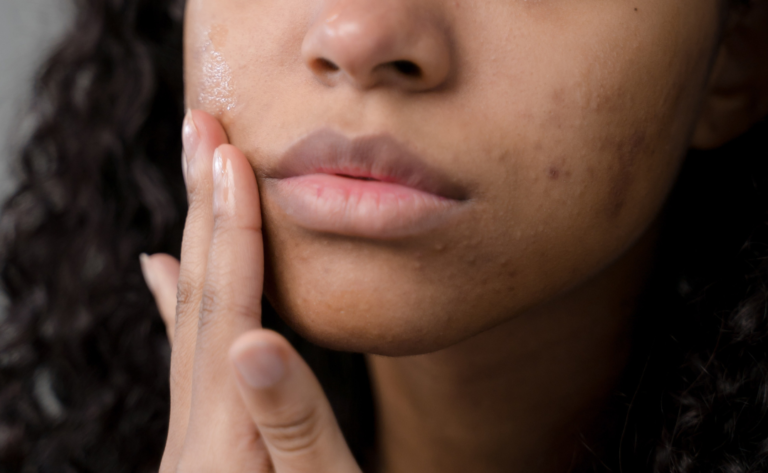 How to fade marks and scars left by spots